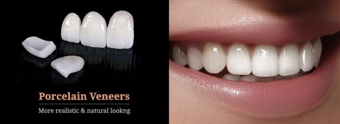 Porcelain veneers